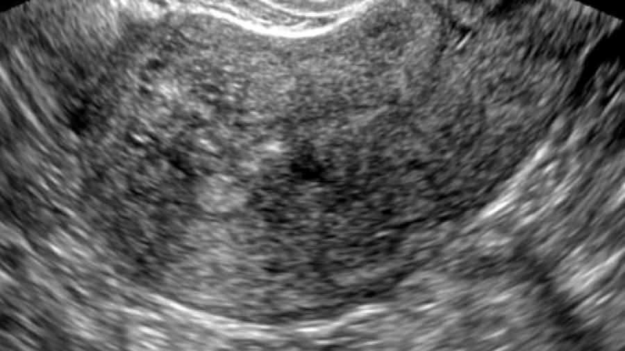 Adenomiose